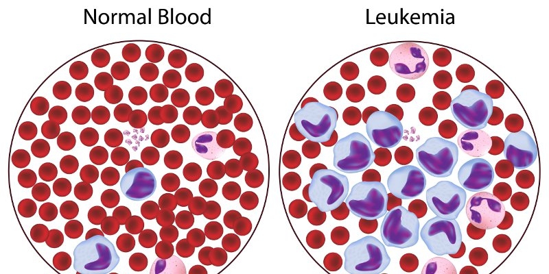 Кровь эозинофилы 10. Эозинофилы рисунок. Лейкозные клетки. Лейкопения после химиотерапии. Уровень эозинофилов при лейкозе.